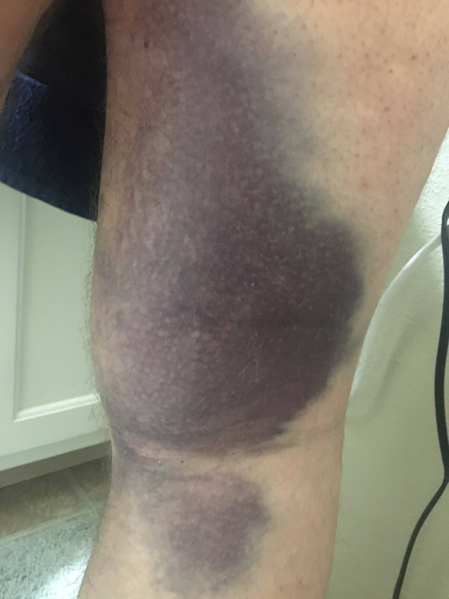 Knee injury